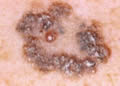 Malignant Melanoma