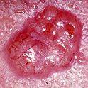 basal cell carcinoma