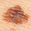 Malignant Melanoma