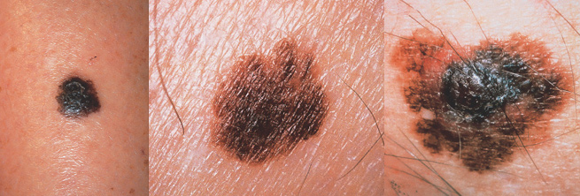 Dermatology Center of Williamsburg Skin Cancer