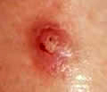 Squamous Cell Carcinoma