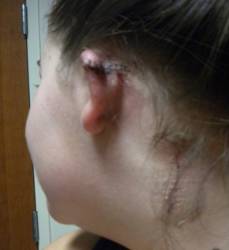 Melanoma on back of ear