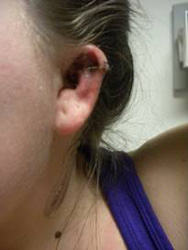 Melanoma on front of ear